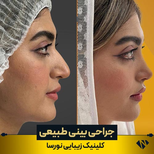 قبل و بعد از عمل بینی