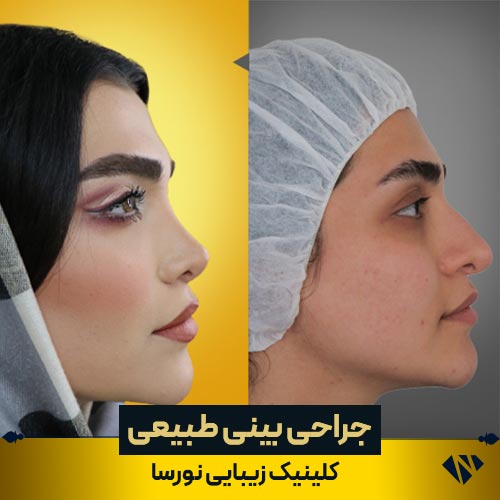 قبل و بعد از جراحی بینی طبیعی