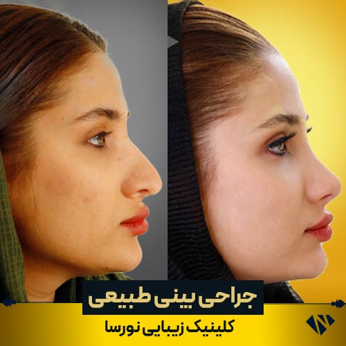 قبل و بعد از جراحی زیبایی بینی