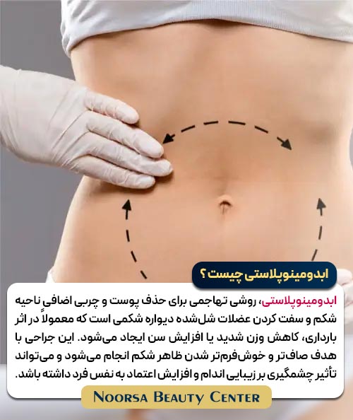 ابدومینوپلاستی چیست