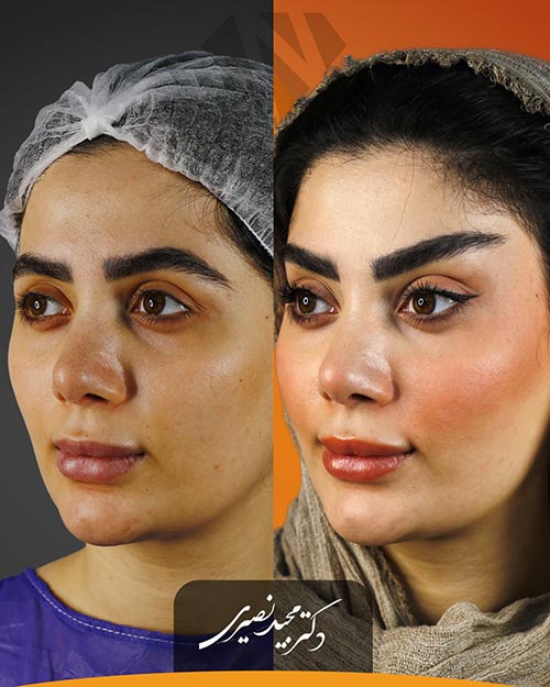 قبل و بعد از جراحی لیفت شقیقه در کلینیک زیبایی نورسا