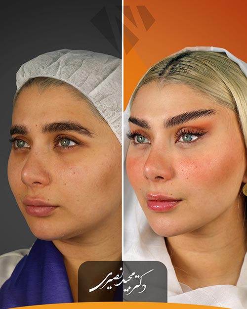 قبل و بعد از جراحی لیفت شقیقه در کلینیک زیبایی نورسا