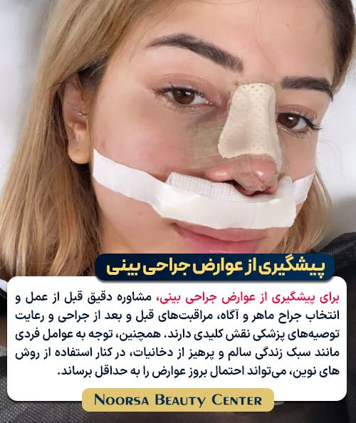 پیشگیری از عوارض رینوپلاستی