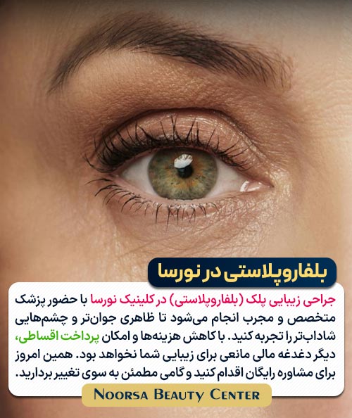 بلفاروپلاستی در کلینیک نورسا