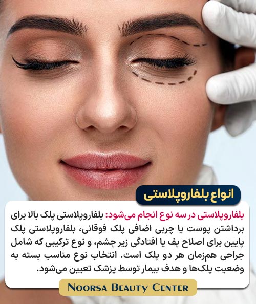 انواع جراحی بلفاروپلاستی