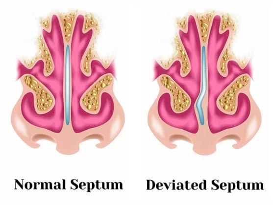 deviated and normal septom