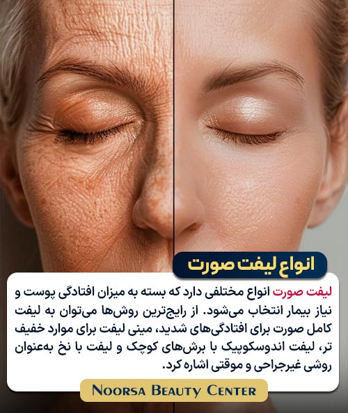 انواع روش های لیفت صورت