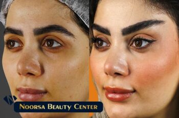 لیفت شقیقه در کلینیک زیبایی نورسا