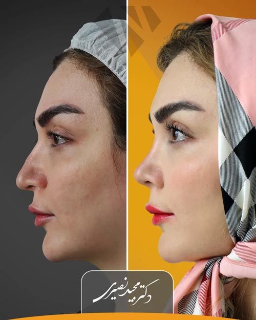 نتیجه عمل بینی در کلینیک زیبایی نورسا