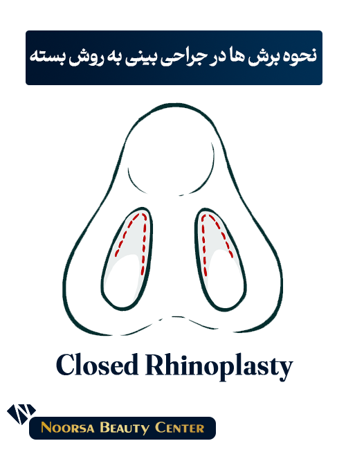 جراحی بینی به روش بسته
