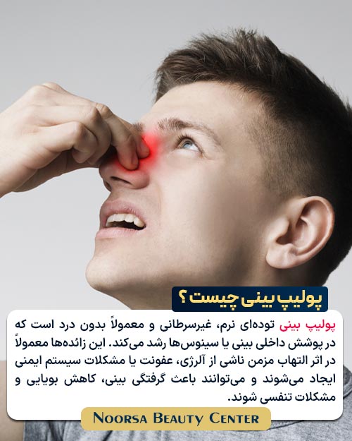 پولیپ بینی