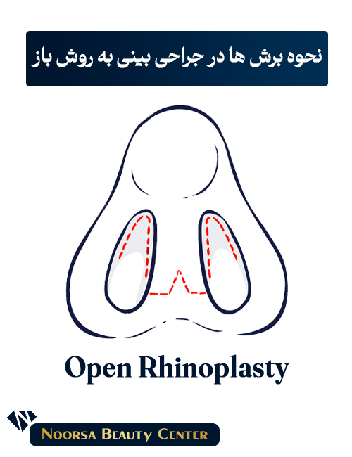 جراحی بینی به روش باز