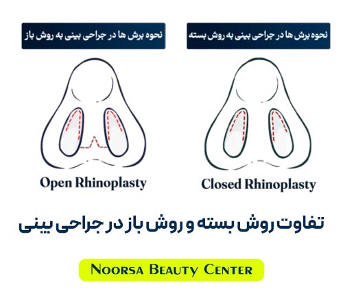 تفاوت روش باز و روش بسته در جراحی بینی