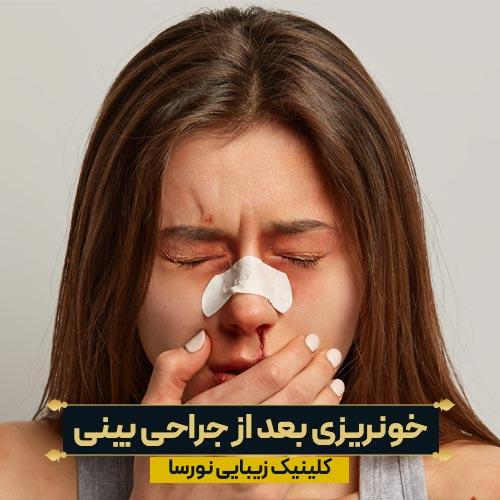 خونریزی بعد از جراحی بینی