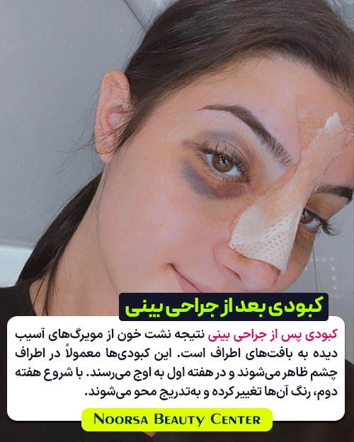 کبودی بعد از جراحی بینی