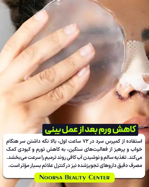 روش های کاهش ورم بعد از عمل بینی