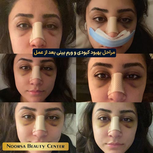 مراحل بهبود کبودی و ورم بینی بعد از عمل