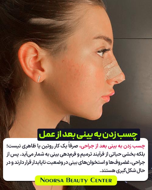 چسب زدن به بینی بعد از عمل