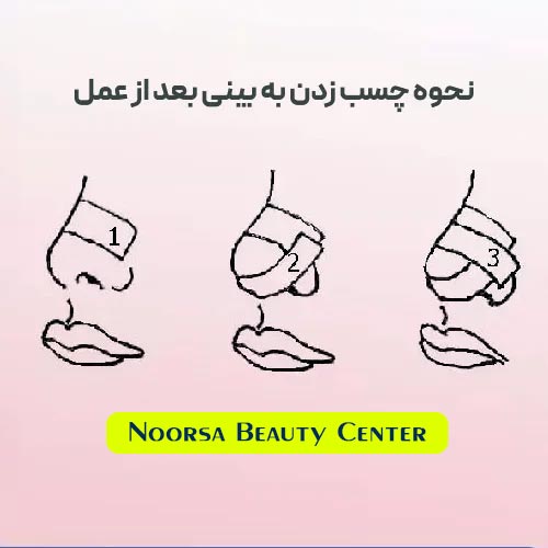 آموزش تصویری نحوه چسب زدن به بینی بعد از جراحی