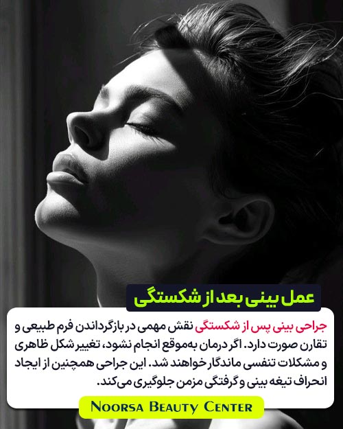 جراحی بینی بعد از شکستگی