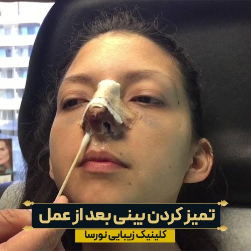 نحوه تمیز کردن بینی بعد از رینوپلاستی