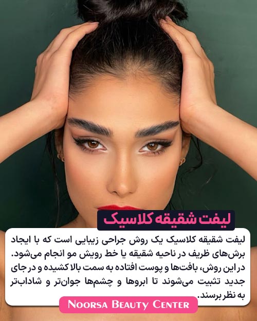 لیفت شقیقه کلاسیک چیست