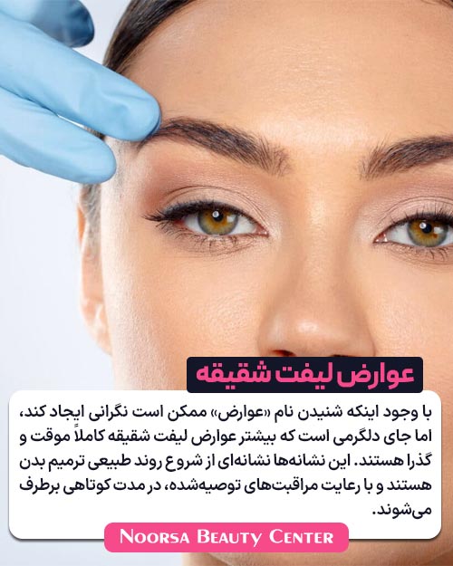 عدم نگرانی از عوارض موقت لیفت شقیقه