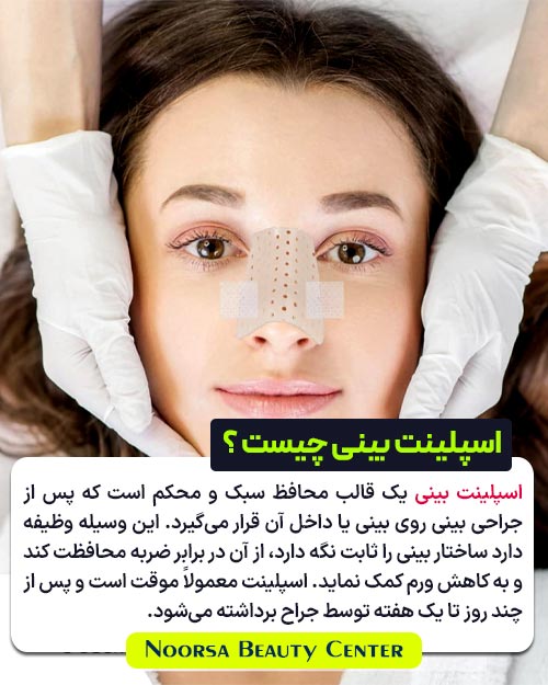 اسپلینت بینی چیست