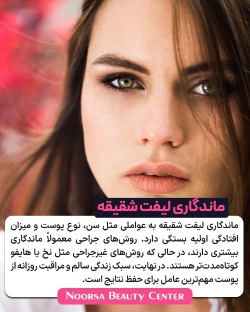 ماندگاری لیفت شقیقه