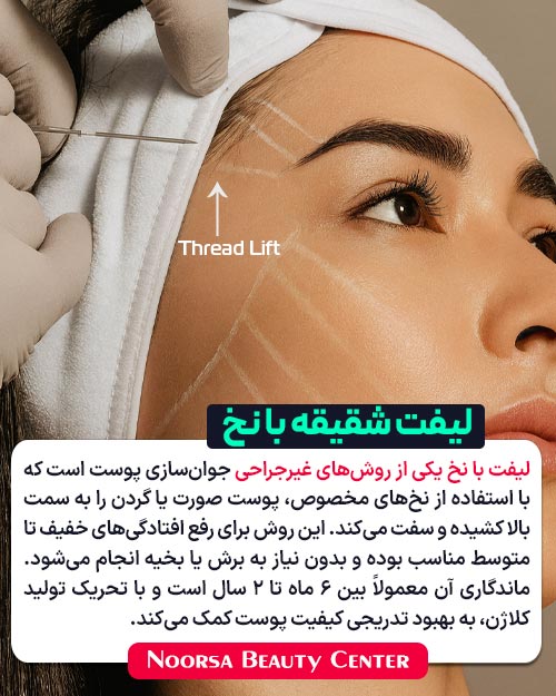 لیفت شقیقه با نخ