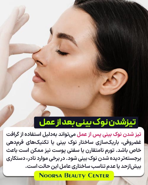 دلایل تیز شدن نوک بینی بعد از عمل