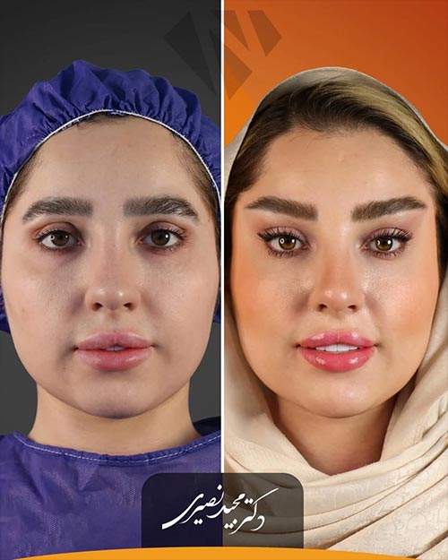 تغییرات بعد از لیفت شقیقه توسط دکتر نصیری