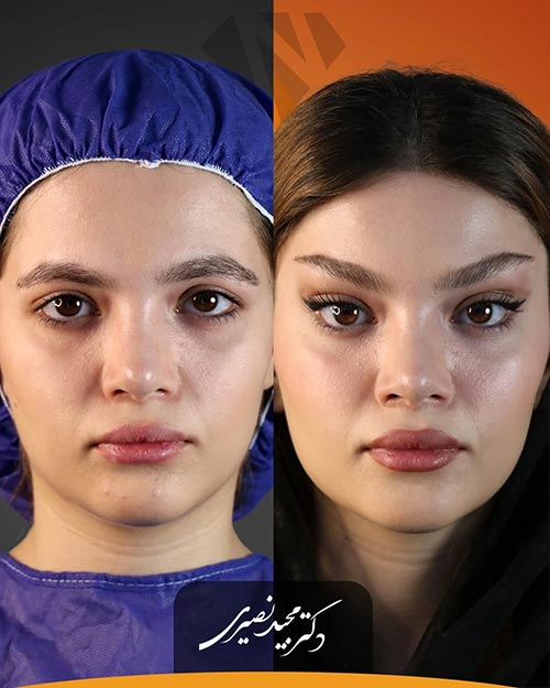 عمل لیفت شقیقه انجام‌شده در کلینیک نورسا توسط دکتر نصیری