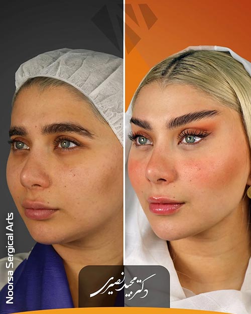 قبل و بعد لیفت شقیقه با تکنیک کم‌تهاجم کلینیک نورسا