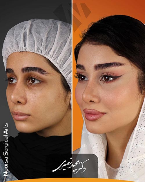 نتیجه لیفت شقیقه بدون بیهوشی عمومی در کلینیک زیبایی نورسا