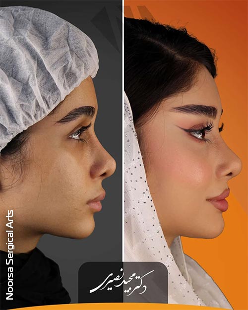 تغییرات بعد از لیفت شقیقه توسط دکتر نصیری