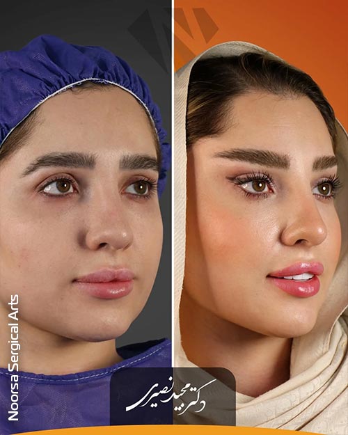 قبل و بعد از لیفت شقیقه در کلینیک زیبایی نورسا