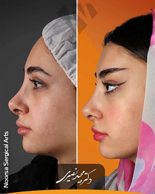 نمونه جراحی لیفت شقیقه کلینیک نورسا با دکتر نصیری