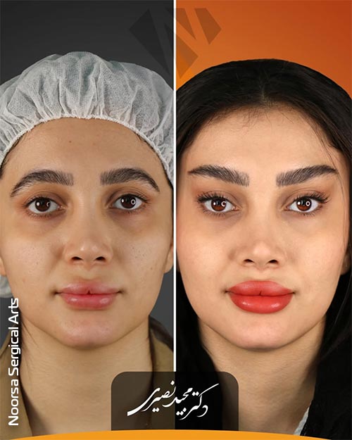 تصویر لیفت شقیقه با تکنیک SMAS دکتر مجید نصیری