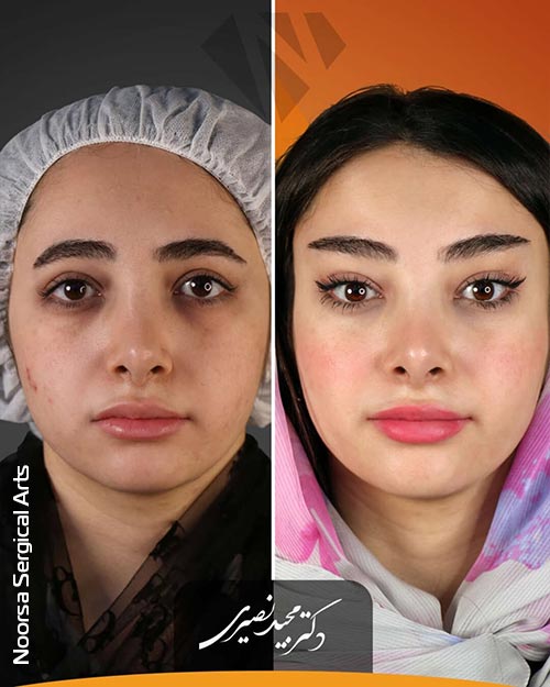 لیفت شقیقه کلاسیک توسط دکتر مجید نصیری