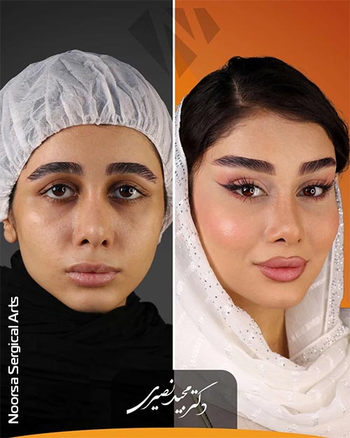 تصویر واقعی قبل و بعد از عمل جراحی لیفت شقیقه