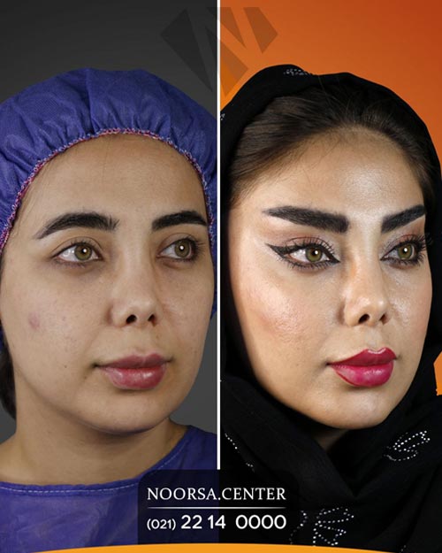 قبل و بعد از جراحی لیفت شقیقه در کلینیک زیبایی نورسا
