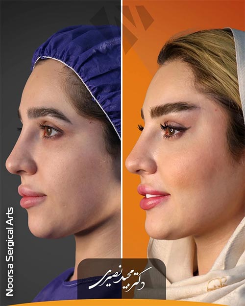 قبل و بعد از جراحی لیفت شقیقه در کلینیک زیبایی نورسا