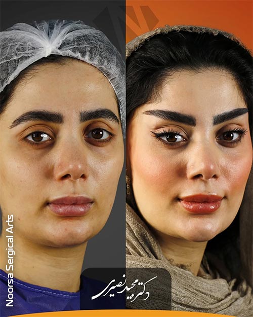 تصویر واقعی از لیفت شقیقه در کلینیک نورسا