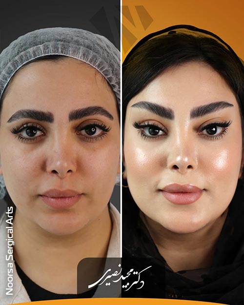تصویر قبل و بعد از لیفت شقیقه با اندوتاین در کلینیک زیبایی نورسا