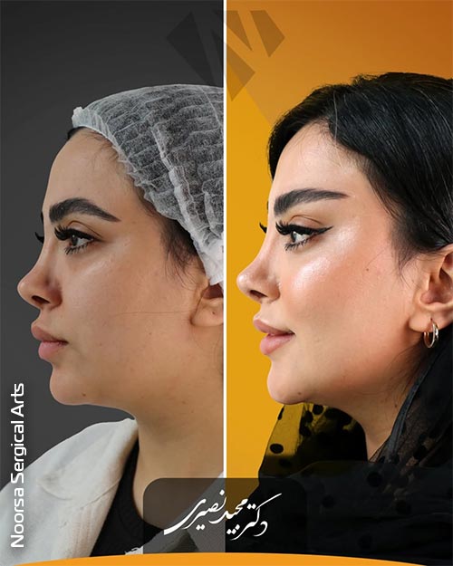 لیفت شقیقه در کلینیک زیبایی نورسا توسط دکتر مجید نصیری