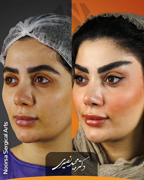 نتیجه لیفت شقیقه به روش کلاسیک در کلینیک زیبایی نورسا