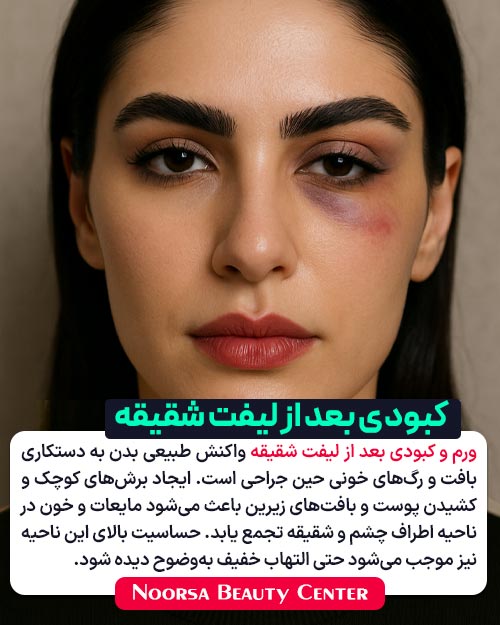 ورم و کبودی صورت بعد از لیفت شقیقه