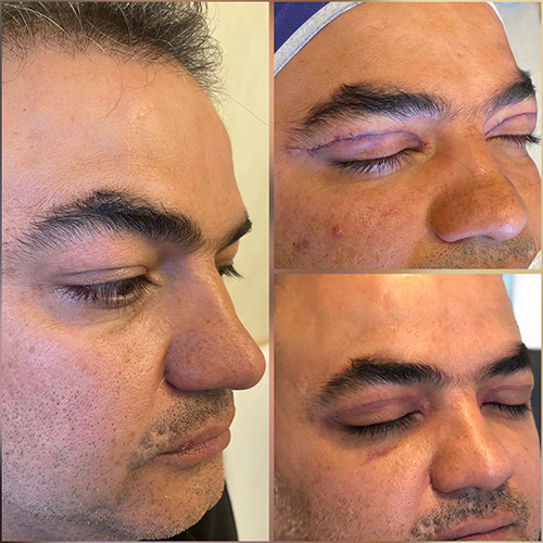 قبل و بعد از جراحی پلک در کلینیک زیبایی نورسا