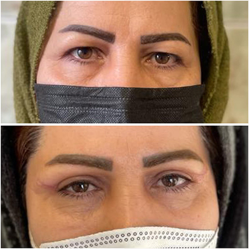 نتیجه بلفاروپلاستی در کلینیک زیبایی نورسا